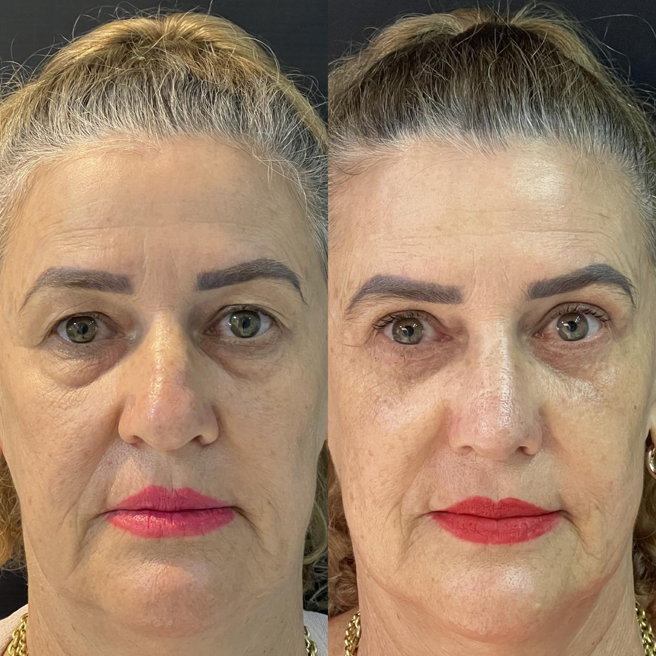 Antes e depois 1