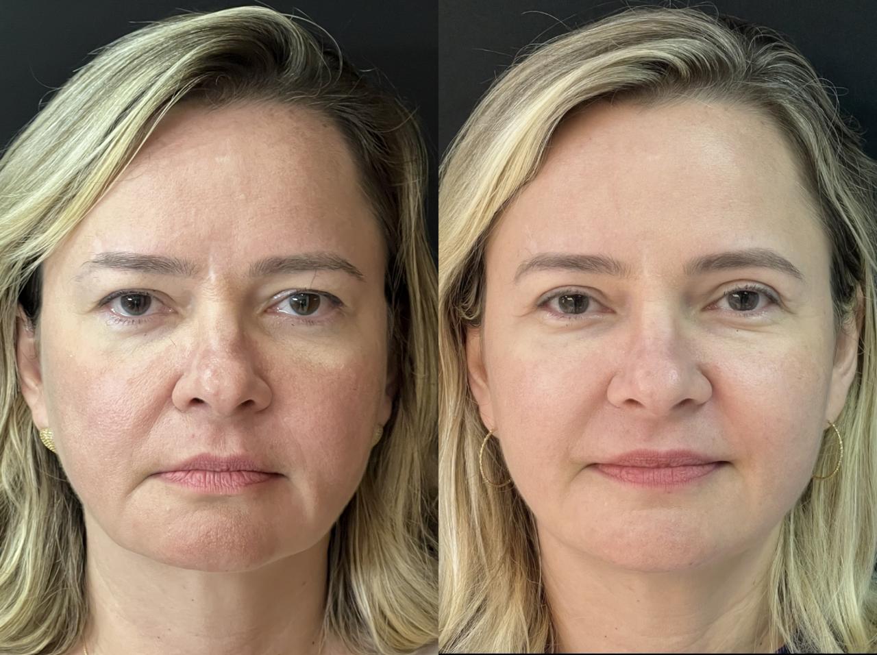 Antes e depois 9